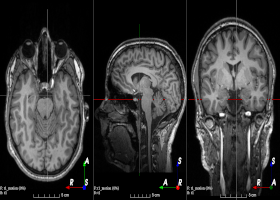 TorchIO: A Python Library for Efficient Patch-based Sampling of Medical Images in Deep Learning